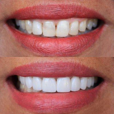 Cosmetic Veneers!