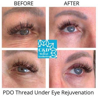 PDO Thread Under Eye Rejuvenation