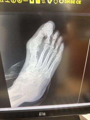 Several bunion and fracture