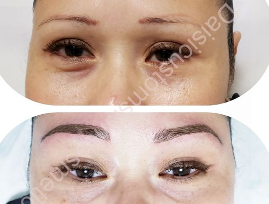 Brow Correction Re-design