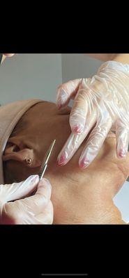 Dermaplaning. Everyone's all time favorite