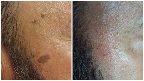 Aging Spot removal. Laser.