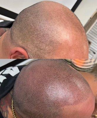 Scalp Micropigmentation Before/After