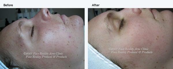 non-inflamed Acne before and after