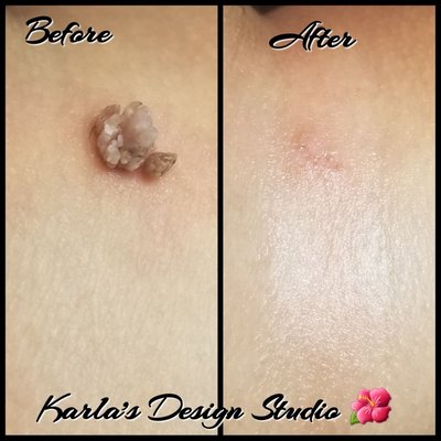 Skin Tag Removal