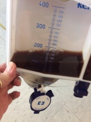 My father was rushed to the hospital with a severe UTI and dehydration. This is a picture of his urine.