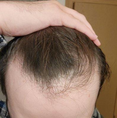 Not enough grafts and hairline is too low.