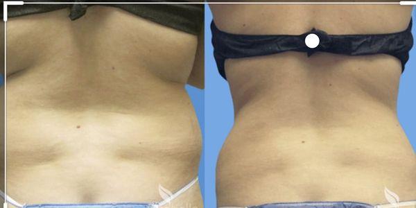 Before and After laser lipo