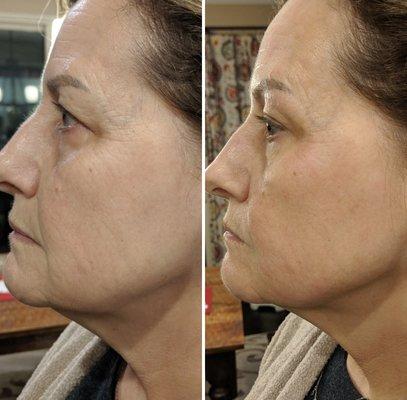 Before and Immediate After Face & Neck Uplift~ Results continue to improve up to 1 year!