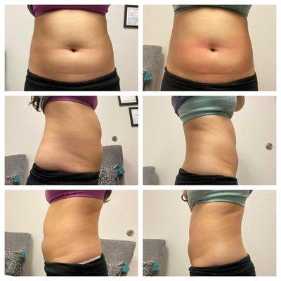 cryo lipo fat freezing easy and non invasive