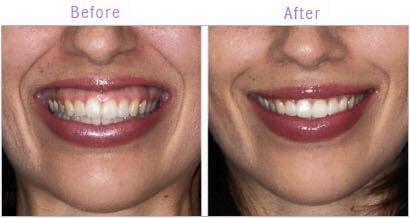 Porcelain Crowns and Invisalign treatment.