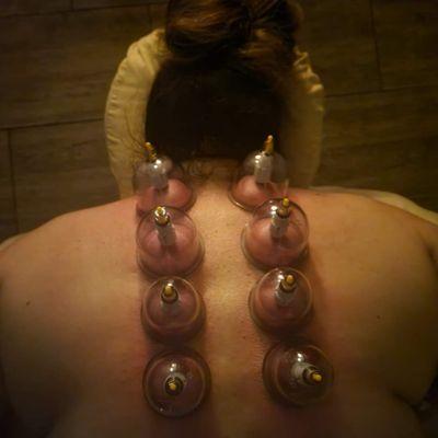 Cupping