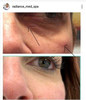 A little filler, Restylane Refyne, in tear trough to create more awake and rested look!