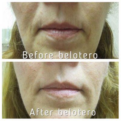 Belotero used to treat fine lines on upper lip