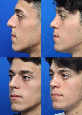 This is a rhinoplasty ("nose job") patient, treated at Garcia Facial Plastic Surgery.