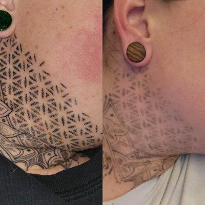 Client photo before and after 6 sessions under the chin. We started the lower part of her neck after about 3 sessions under her chin.