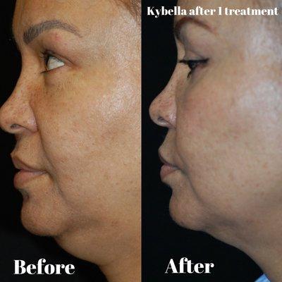 Before and After results of Kybella® treatment at Spatologie