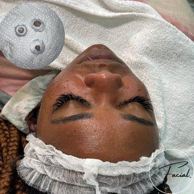 Microdermabrasion