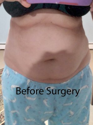 My belly before surgery