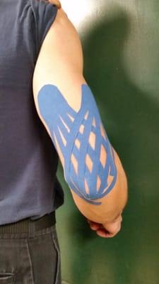 Kinesio Taping used to reduce swelling in the elbow due to a contusion