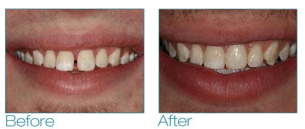 We closed the space between Brennan's two front teeth with cosmetic bonding.