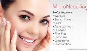 Microneedling PRP