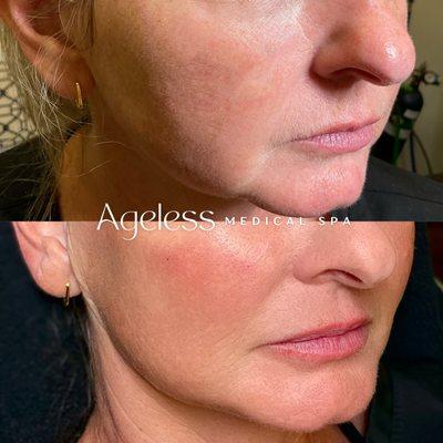 Ageless Filler Results