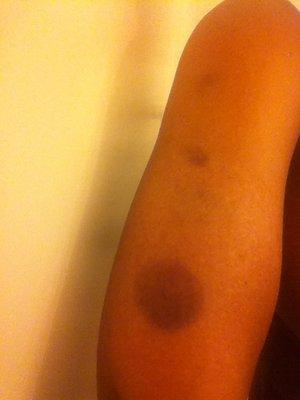 Bruises on my arm from a massage at One Spa.