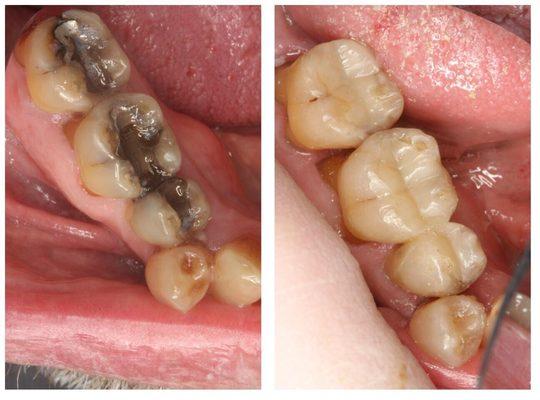 Silver Mercury amalgam filling replacement