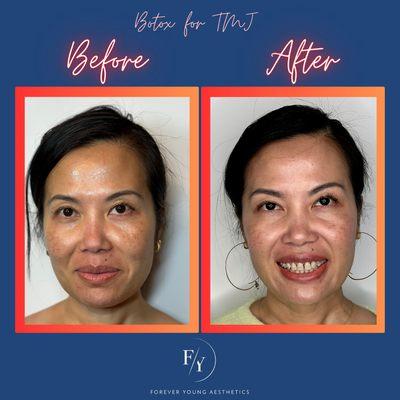 Jaw facial slimming/TMJ Botox treatment
#botoxmasseter