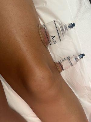 Cupping for treatment of knee tendonitis