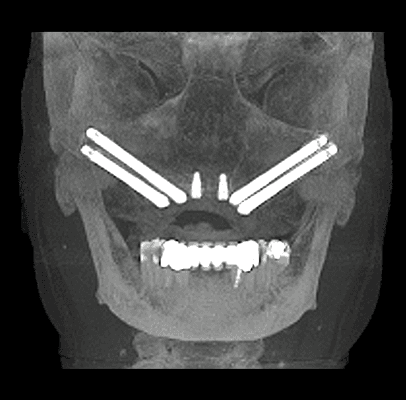 TMJ Disorders Severna Park, MD