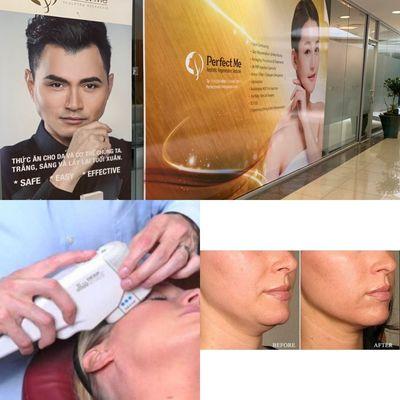 Ulthera therapy for face lifting, produce collagen n brighten the skin