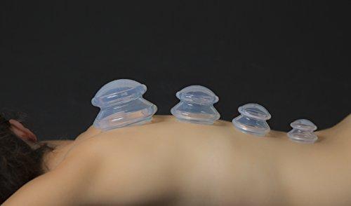 Cupping