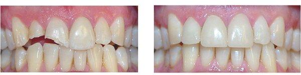 Patient had a bicycle accident. His fractured teeth were restored in one visit using our CAD/CAM Cerec technique.