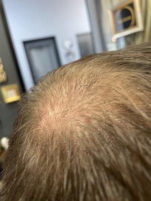 Microneedling did wonders for my hair . Worth the price!