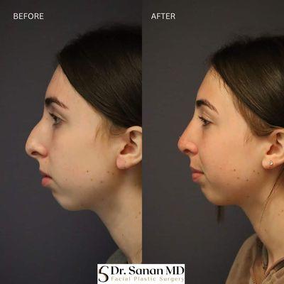 Female Rhinoplasty