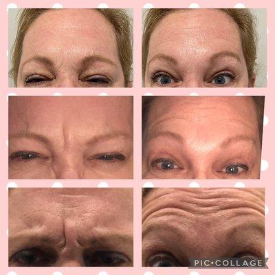 BOTOX Pre and Post Treatment