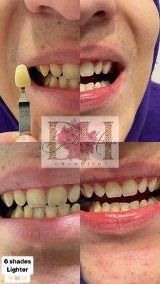 Tooth whitening