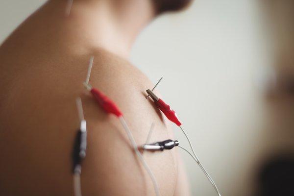 Electrical stimulation is a modern acupuncture technique connecting two points with electricity to reduce inflammation and decrease pain.