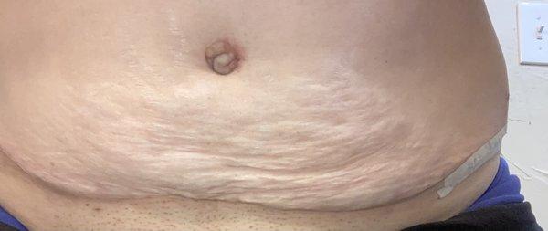 Post op flab