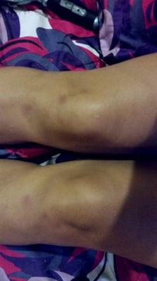 My knees the morning after.