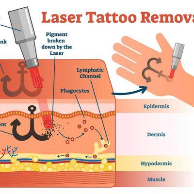 Laser Tattoo Removal in Downtown Glenwood Springs