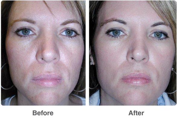 A series of three chemical peels.  Call for free consultation.