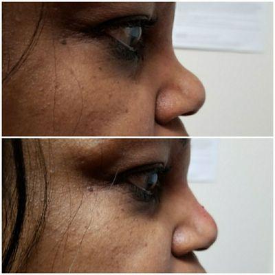 Non- surgical nose job.
Filler injection.