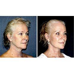 Endoscopic Browlift and Facelift