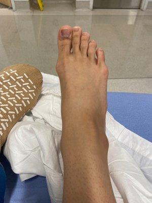 Before right foot bunion surgery