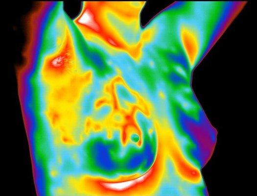 An abnormal infrared image (thermogram) is the single most important marker of high risk for developing breast cancer.