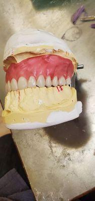 Full Denture setup with kenson teeth