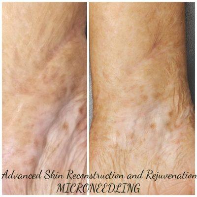 Advanced Skin Rejuvenation. Burn Scarring